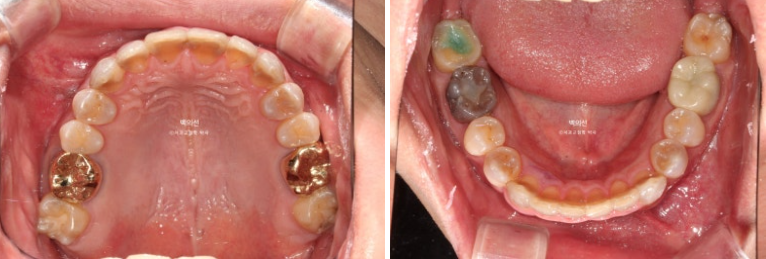 Treatment Review: No-Prep Laminate for Tetracycline-Stained Teeth image 11