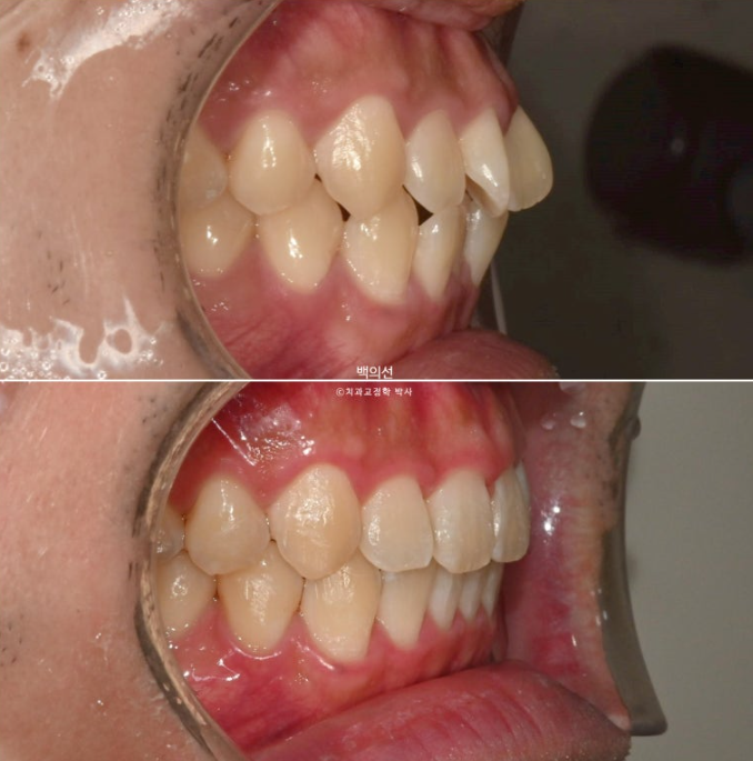 가위교합 나비치아 미니스크류 덧니 교정 인비절라인 라이트 관련 이미지 22