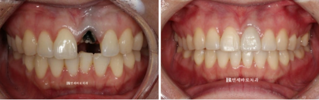 임플란트 없이 자연치아 살리기 앞니 부분교정 보철교정 관련 이미지 6