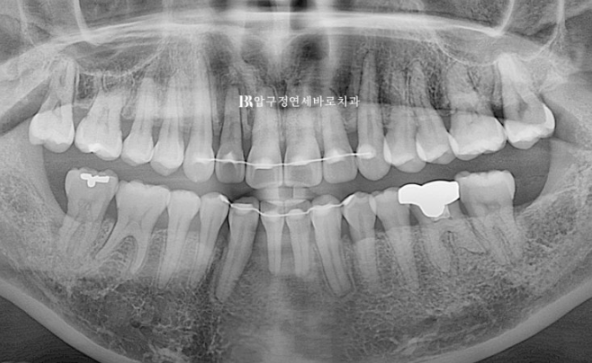 40대 치아교정 가능할까요? 치주염 있어도 치아교정 가능할까요? 임플란트 없이 교정하기 관련 이미지 17