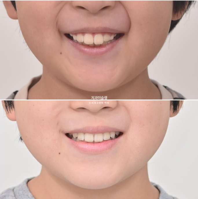 어린이 돌출입 교정 무턱 투명교정 인비절라인 퍼스트 관련 이미지 25