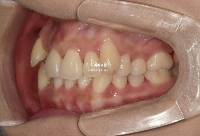 인비절라인 비발치 제2대구치 발치 사랑니 대체 교정 심한 덧니 교정 치료 관련 이미지 4