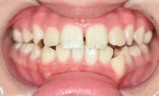 어린이 투명교정 인비절라인 틴 덧니 교정 후기 관련 이미지 2