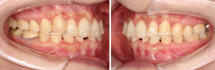 해외거주 앞니 선천적 결손 과개교합 인비절라인 라이트 브릿지 치료 관련 이미지 11
