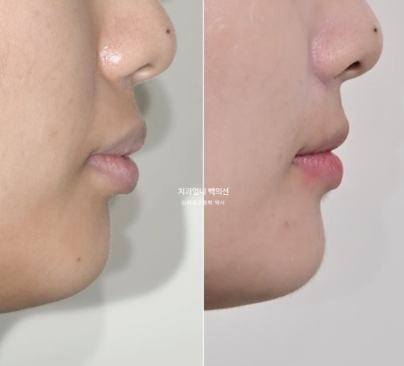 돌출입 교정 인비절라인 발치 교정 후기 관련 이미지 21