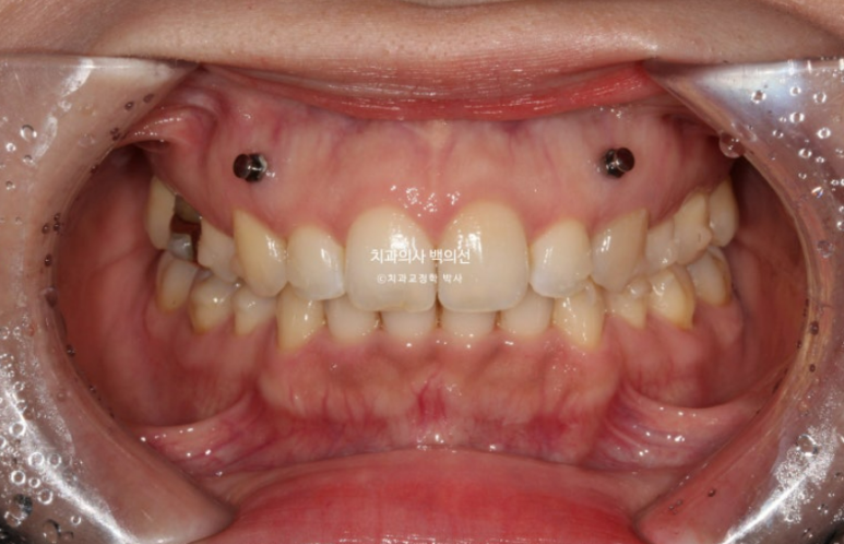 인비절라인 라이트 재교정 발치공간 벌어짐 ? 관련 이미지 5