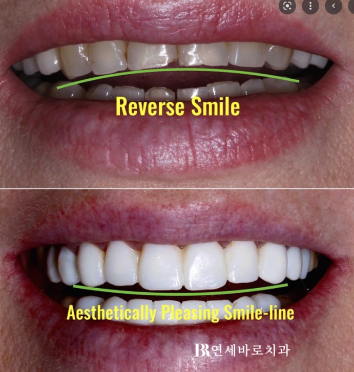 잇몸미소 거미스마일 원인에 따라 다른 치료방법? 관련 이미지 5
