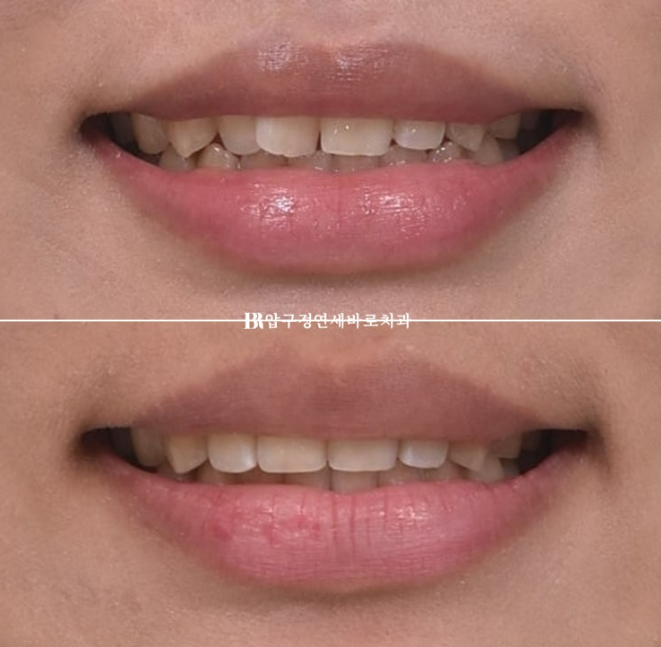 압구정 교정치과 덧니 부분교정 단기교정 후기 관련 이미지 11