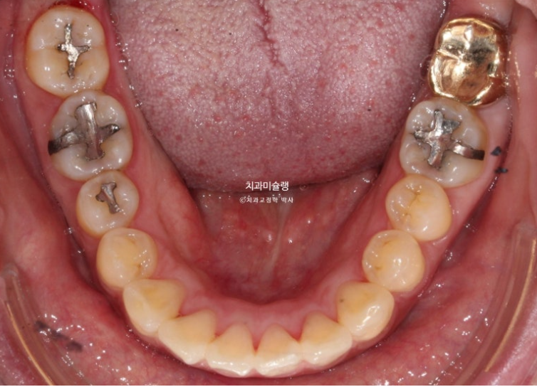 Extraction Orthodontics with Clippy-C for Protruding Mouth, Gum Smile, Gummy Smile Correction, and Treatment for a Recessed Chin image 5