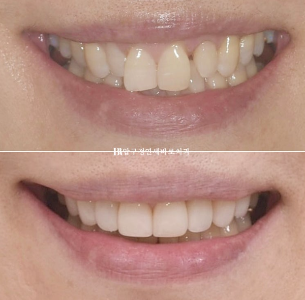 50s Invisalign Lite No-Prep Laminate Bunny Teeth image 1