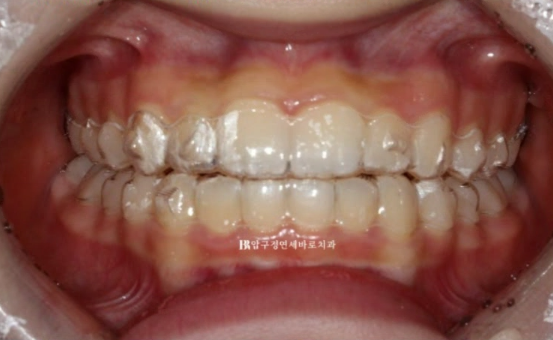 서울 인비절라인 덧니 교정 과개교합 후기 관련 이미지 6