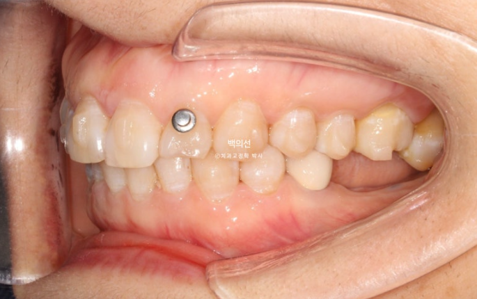40대 인비절라인 라이트 앞니 돌출 과개교합 덧니 교정 후기 관련 이미지 9