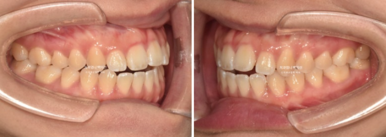 앞니 단기 부분교정 재교정 개방교합 교정 후기 관련 이미지 3