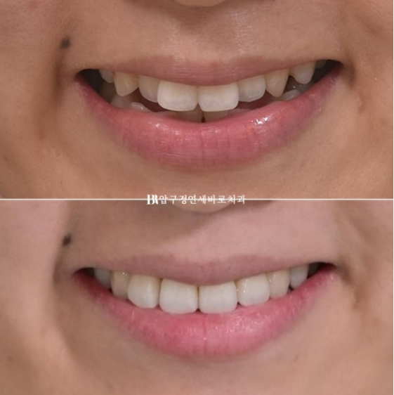 Gangnam Orthodontic Clinic: A Woman in Her 30s’ Rabbit Teeth Correction Review|Six-Month Front Teeth Partial Orthodontic Treatment That Also Improved a Crossbite image 11