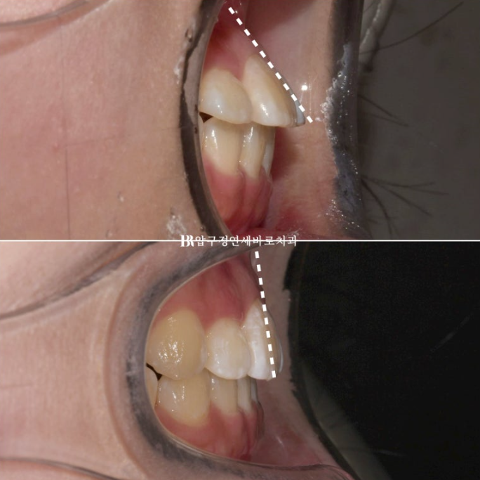 인비절라인라이트 재교정 뻐드렁니 교정 돌출 교정 관련 이미지 7