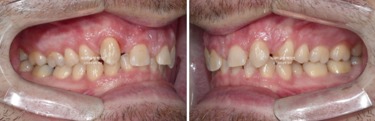 앞니 선천적 결손 인비절라인 임플란트 과개교합 치료 기간 관련 이미지 3