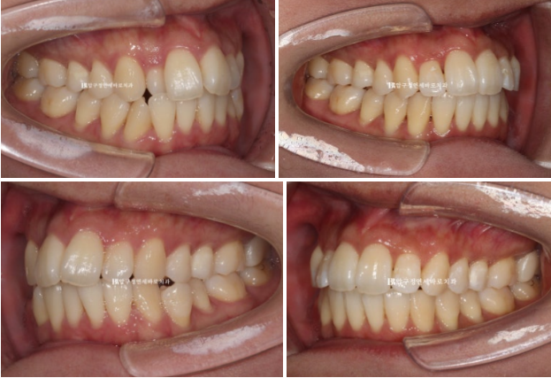 예비신부 교정 단기 앞니 부분교정 치료기간 6개월 관련 이미지 13