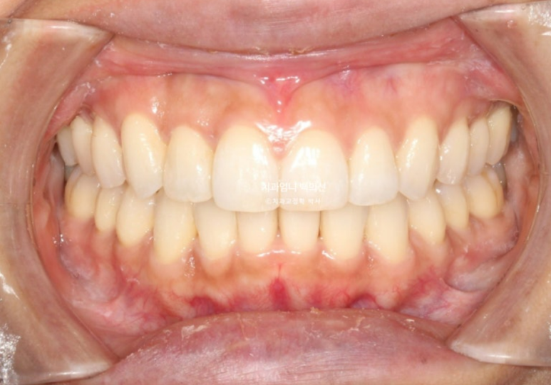 인비절라인 비발치 덧니 교정 반대교합 치료 후기 관련 이미지 13