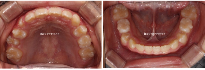 Pediatric Clear Aligners That Improved Both Deep Bite and Protruding Teeth image 8