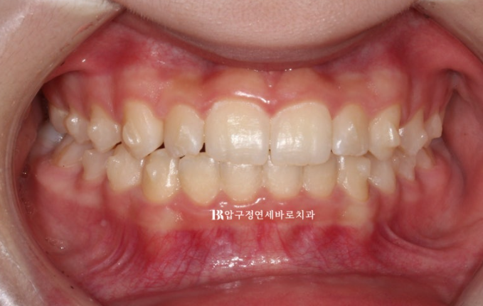 인비절라인라이트 덧니 과개교합 교정 치료기간 9개월 관련 이미지 2