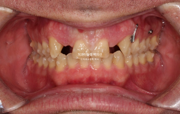 앞니 선천적 결손 인비절라인 임플란트 과개교합 치료 기간 관련 이미지 11