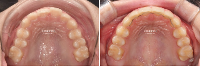 과개교합 인비절라인 모더레이트 컴프레헨시브 중심선 토끼이빨 관련 이미지 13