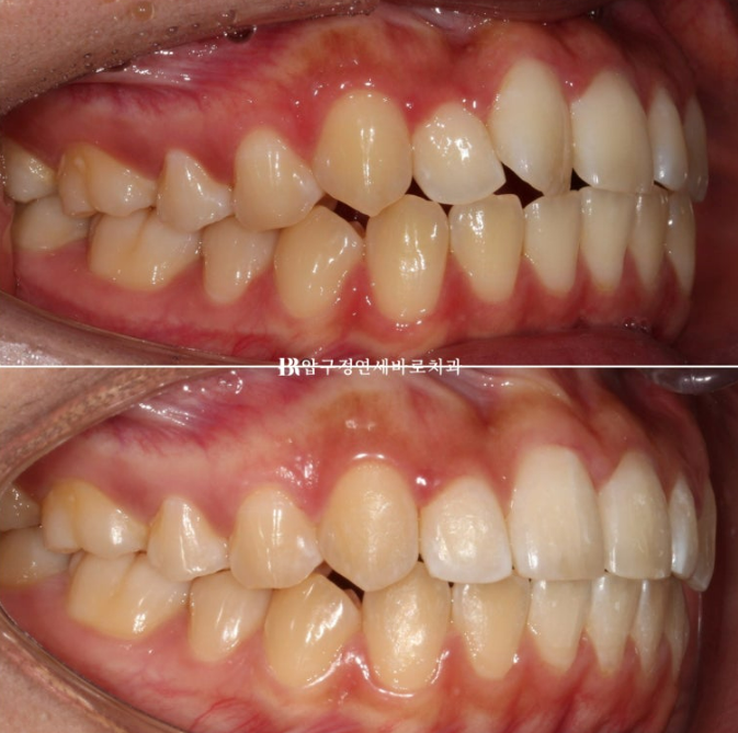 압구정 교정치과 덧니 부분교정 단기교정 후기 관련 이미지 9