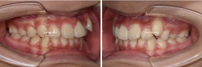 덧니 돌출입 발치교정 상악만 2개 편악 발치 클리피씨 입술부전증 치료 관련 이미지 4