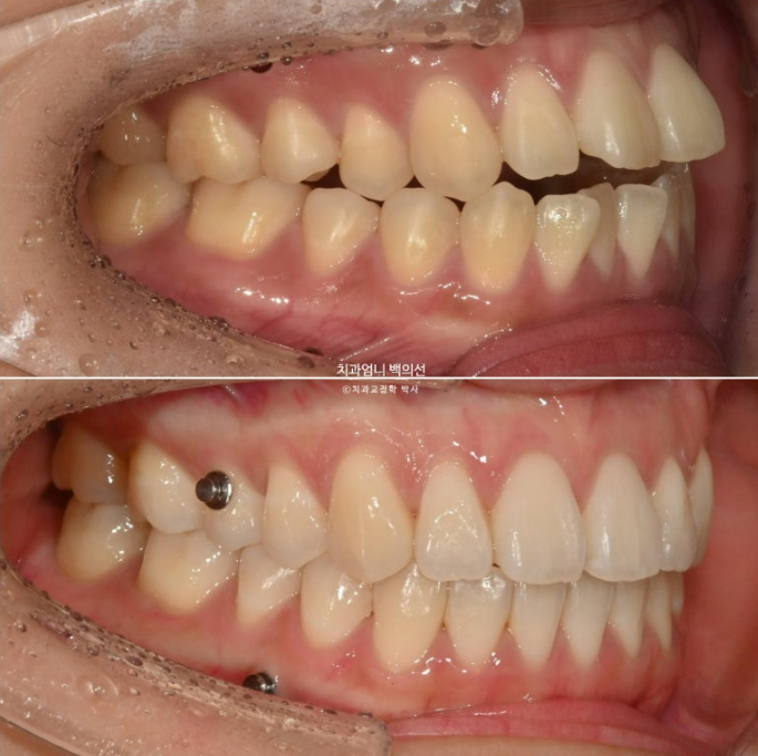 인비절라인 개방교합 교정 어금니 함입 교정 비베라? 관련 이미지 13