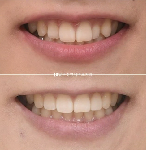 급속 교정 앞니부분교정 치료 무삭제 라미네이트 후기 관련 이미지 14