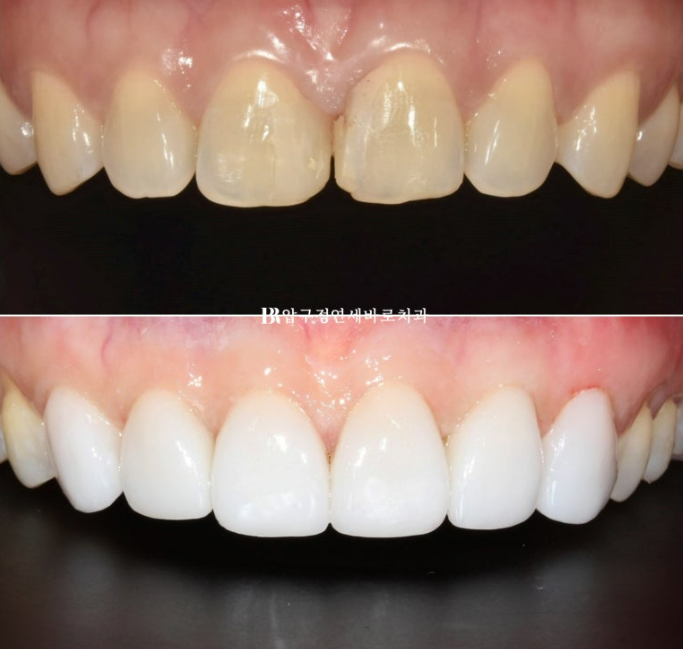 벌어진 치아 교정 인비절라인 라이트 무삭제 라미네이트 치료 관련 이미지 21