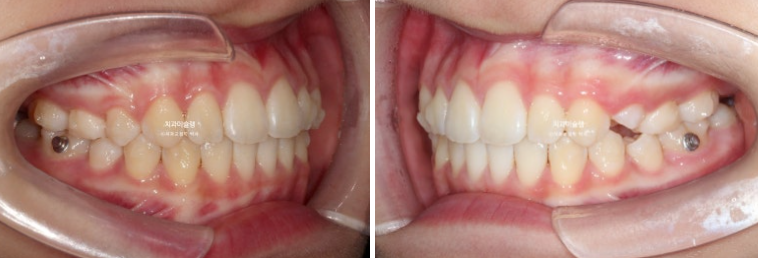돌출입 비발치 어린이 교정 입술부전증 호두주름 호두턱 토끼이빨 인비절라인퍼스트 관련 이미지 9