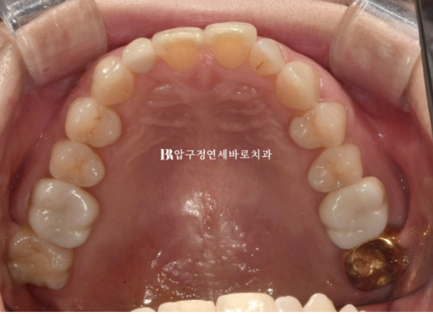 40대 인비절라인 라이트 가위교합? 관련 이미지 5