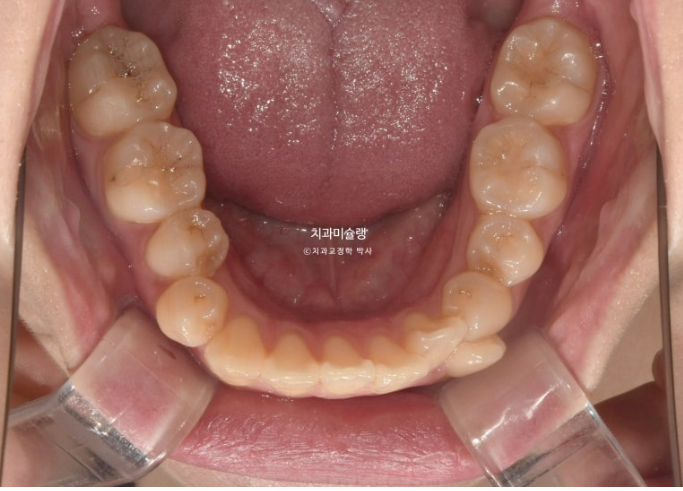 30대 인비절라인 덧니 발치교정 개방교합 치료 관련 이미지 6