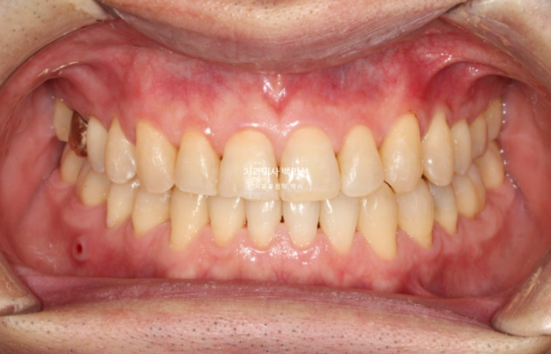 40대 인비절라인 비수술 비발치 주걱턱 비대칭 교정 관련 이미지 9