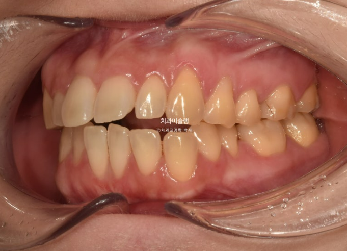 비발치 인비절라인 교정 편측 개방교합 가위교합 돌출 재교정 관련 이미지 4