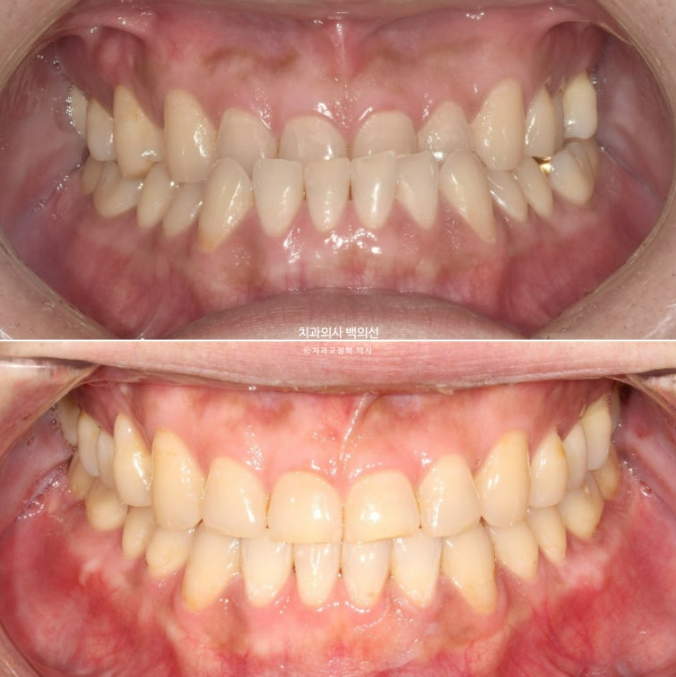 30대 주걱턱 비수술 비발치 교정 후기 관련 이미지 8