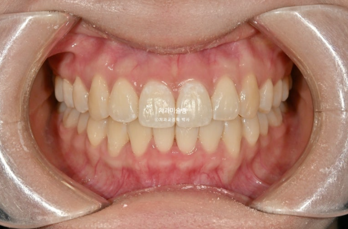 인비절라인 비발치 토끼이빨 교정 덧니 교정 치료기간 1년 8개월 관련 이미지 10