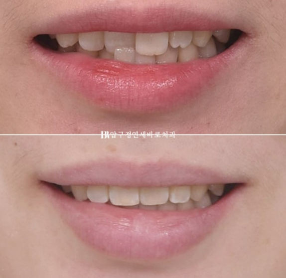 앞니부분교정 기간? MTA 미니튜브 교정 반대교합 교정 관련 이미지 9