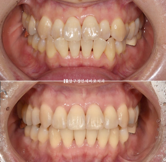 Orthodontics in Your 40s: Worried Your Gums Will Recede? | A 6-Month Front Teeth Partial Orthodontic Case That Also Improved Black Triangles image 1