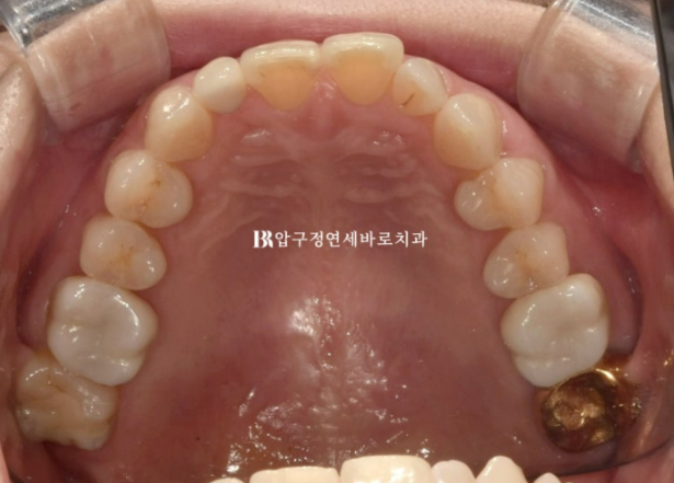 40대 발치교정 대신 인비절라인 라이트? 10개월 치료로 어디까지 가능할까요? 관련 이미지 5