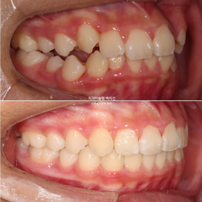 덧니 반대교합 과개교합 인비절라인 퍼스트 악궁확장 어린이 교정 치료 관련 이미지 25