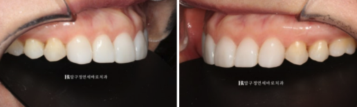 Laminate Veneers in Your 50s: Is It Possible Without Shaving Down the Teeth? | No-Prep Laminate Veneers + Real Case of Front Tooth Partial Orthodontics image 8