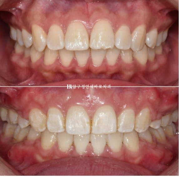 돌출입 교정 입동굴 클리피씨 교정 후기 관련 이미지 12