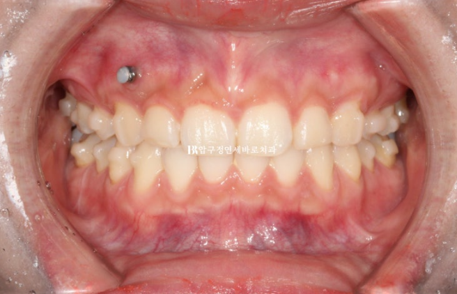 Does Invisalign Prevent Root Movement? Before-and-After Comparison of Extraction Treatment for Protruding Lips image 6
