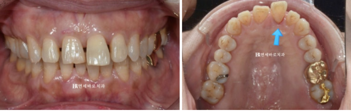 50대 치아벌어짐 단기 교정 가능할까요? 관련 이미지 2