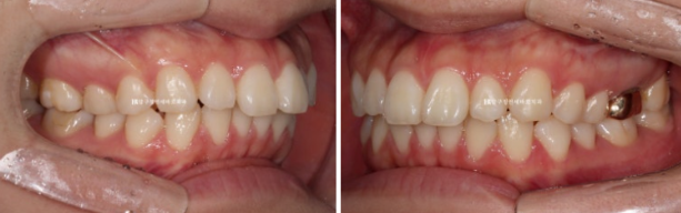 Gummy Smile Correction Review | Natural Improvement of Gummy Smile and Buccal Corridors Through Extraction Treatment for Protruding Teeth image 4