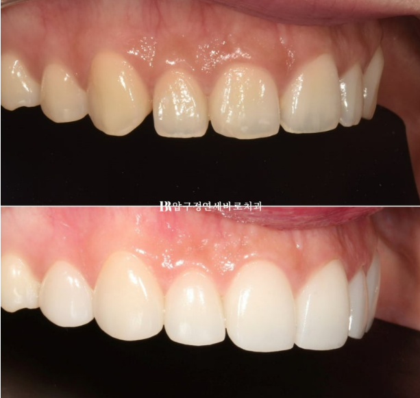 How to Create a Beautiful Smile Line? | A Real Case of Changing a Smile with No-Prep Laminates image 11