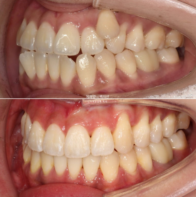 비발치 교정 덧니 인비절라인 교정 절단교합 반대교합 치료기간 1년 6개월 관련 이미지 22