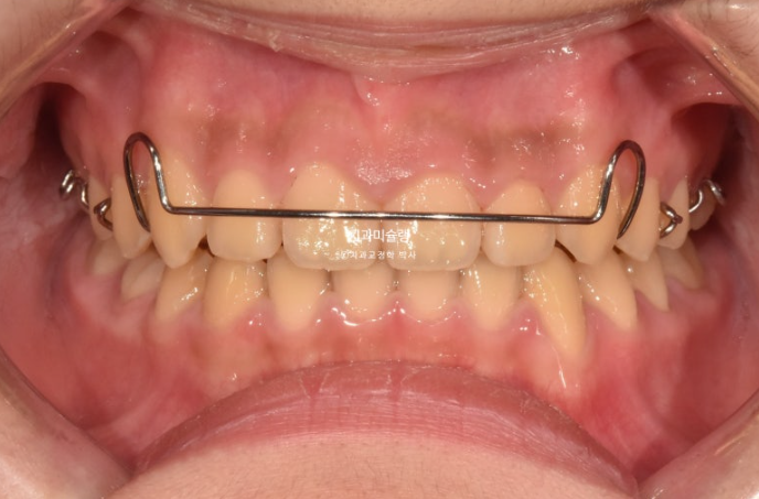 선천적 결손 잔존유치 과개교합 돌출입 인비절라인 퍼스트 어린이 투명교정 치료기간 관련 이미지 17